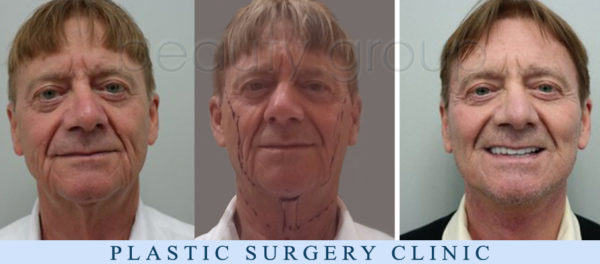 Augusto from Italy - facelift, necklift - Plastic Surgery - BeautyGroup